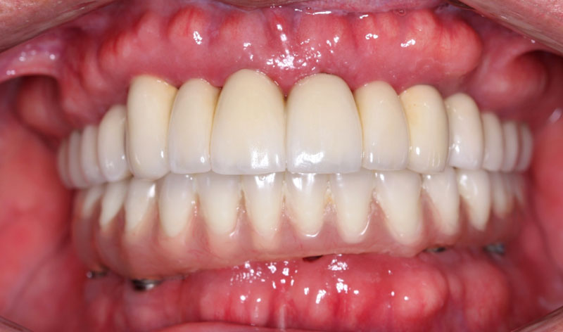 4 dental implants in Cancun
